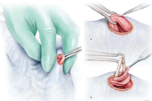 Fonte: Shergill I, et al. Surgery Illustrated – Surgical Atlas – Vasectomy illustrated. BJU Int. 2012, 10 9 , 1116–1127.